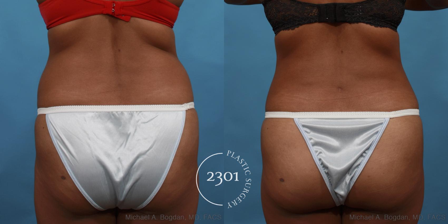 Before & After Tummy Tuck Case 508 View #5 View in Fort Worth, Plano, & Frisco, Texas