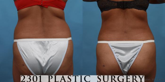 Before & After Tummy Tuck Case 508 View #5 View in Fort Worth, Plano, & Frisco, Texas