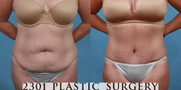 Before & After Tummy Tuck Case 515 View #1 View in Fort Worth, Plano, & Frisco, Texas