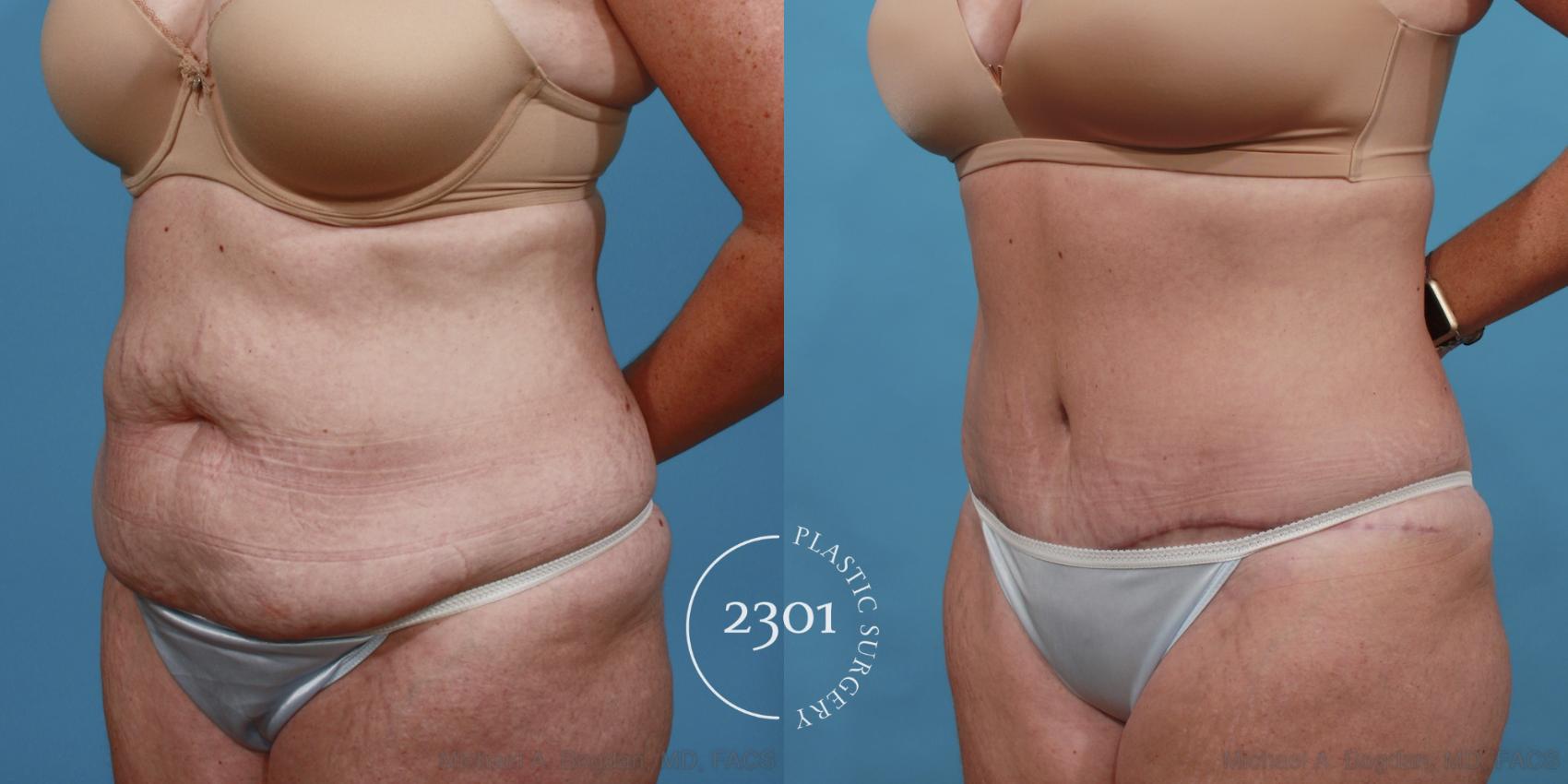 Before & After Tummy Tuck Case 515 View #2 View in Fort Worth, Plano, & Frisco, Texas