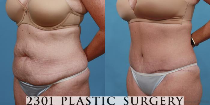 Before & After Tummy Tuck Case 515 View #2 View in Fort Worth, Plano, & Frisco, Texas