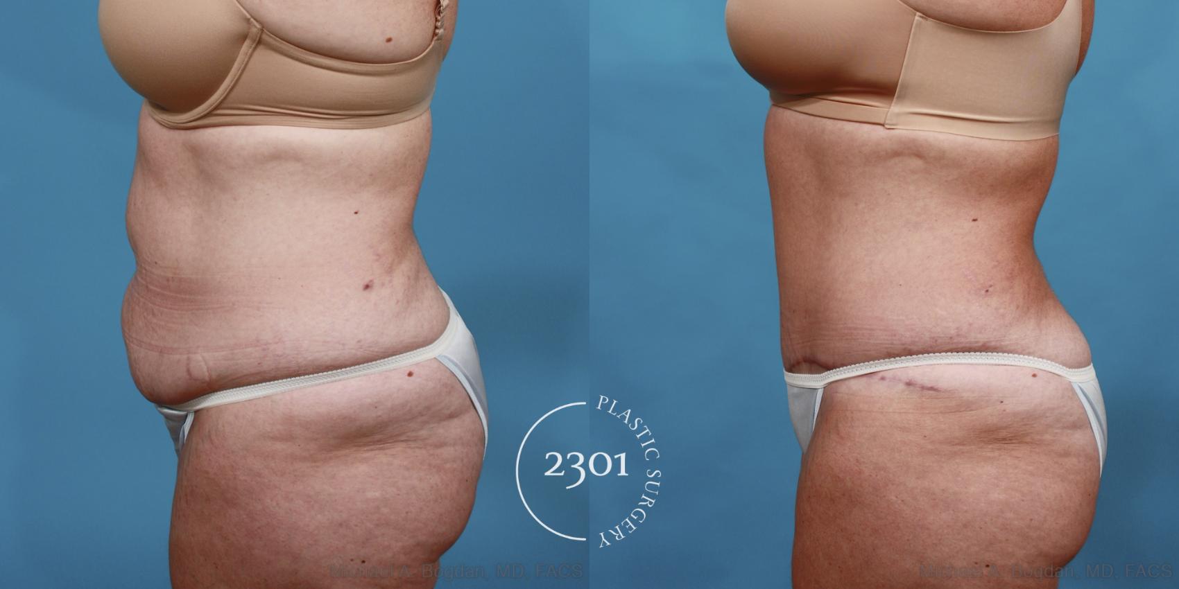 Before & After Tummy Tuck Case 515 View #3 View in Fort Worth, Plano, & Frisco, Texas