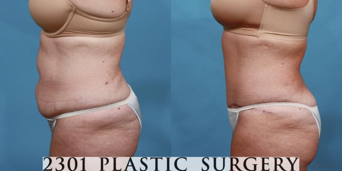 Before & After Liposuction Case 515 View #3 View in Fort Worth, Plano, & Frisco, Texas