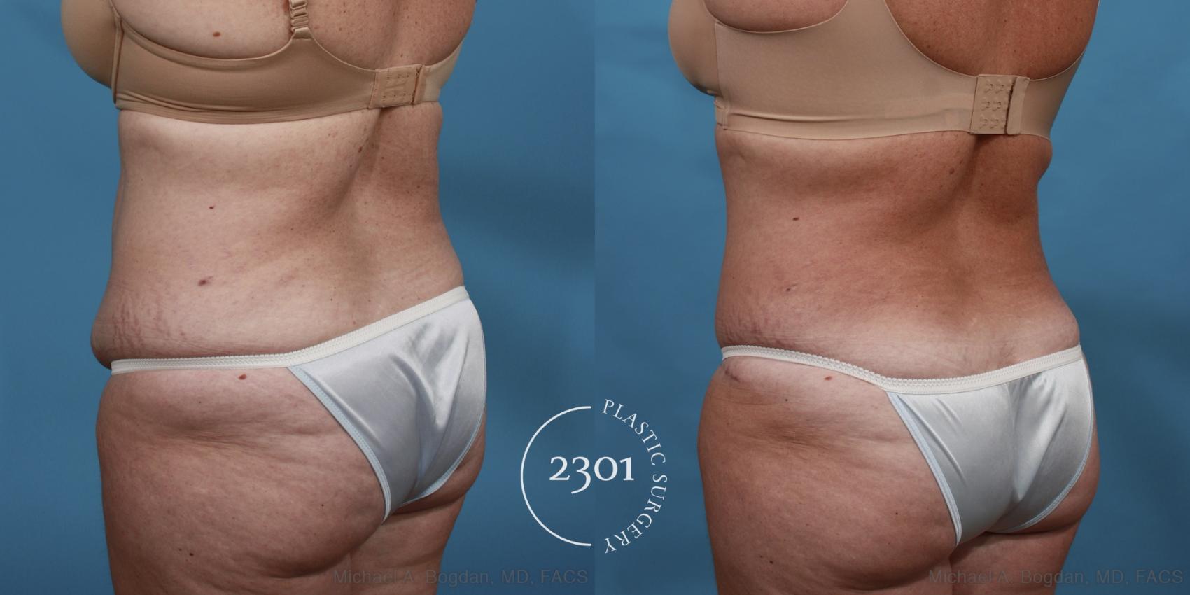 Before & After Tummy Tuck Case 515 View #4 View in Fort Worth, Plano, & Frisco, Texas