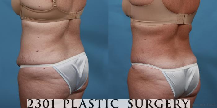 Before & After Liposuction Case 515 View #4 View in Fort Worth, Plano, & Frisco, Texas