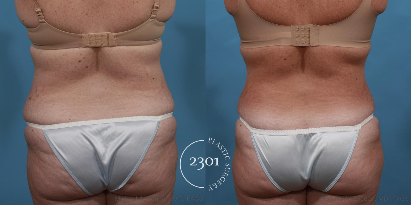 Before & After Tummy Tuck Case 515 View #5 View in Fort Worth, Plano, & Frisco, Texas