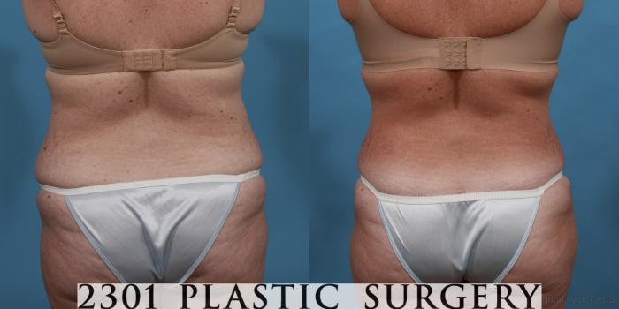 Before & After Liposuction Case 515 View #5 View in Fort Worth, Plano, & Frisco, Texas