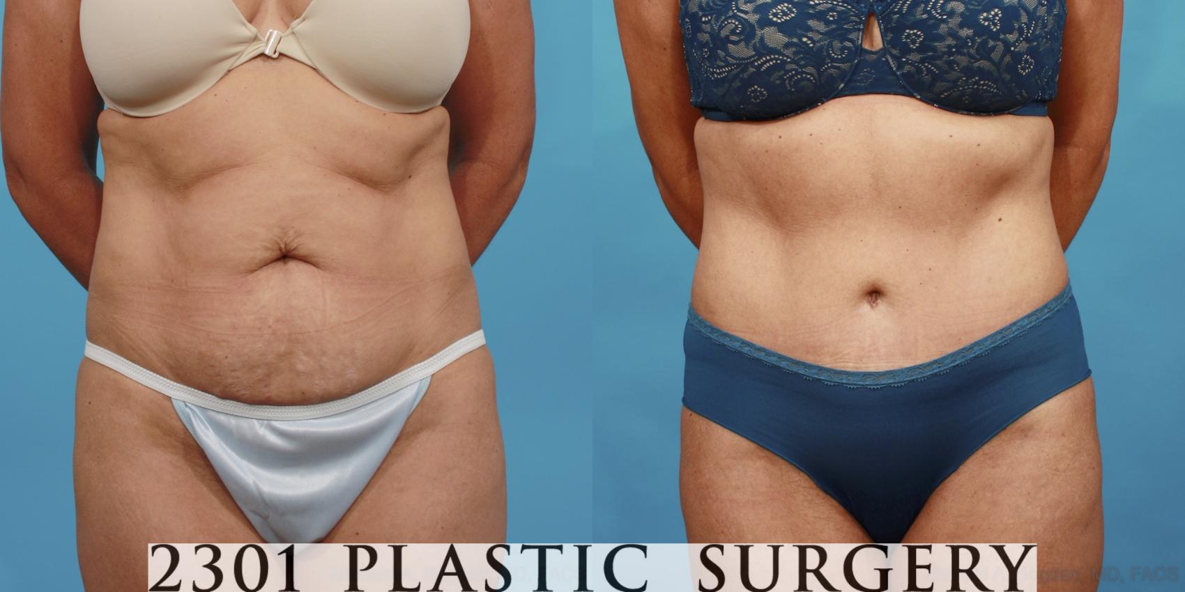 Before & After Tummy Tuck Case 521 View #1 View in Fort Worth, Plano, & Frisco, Texas