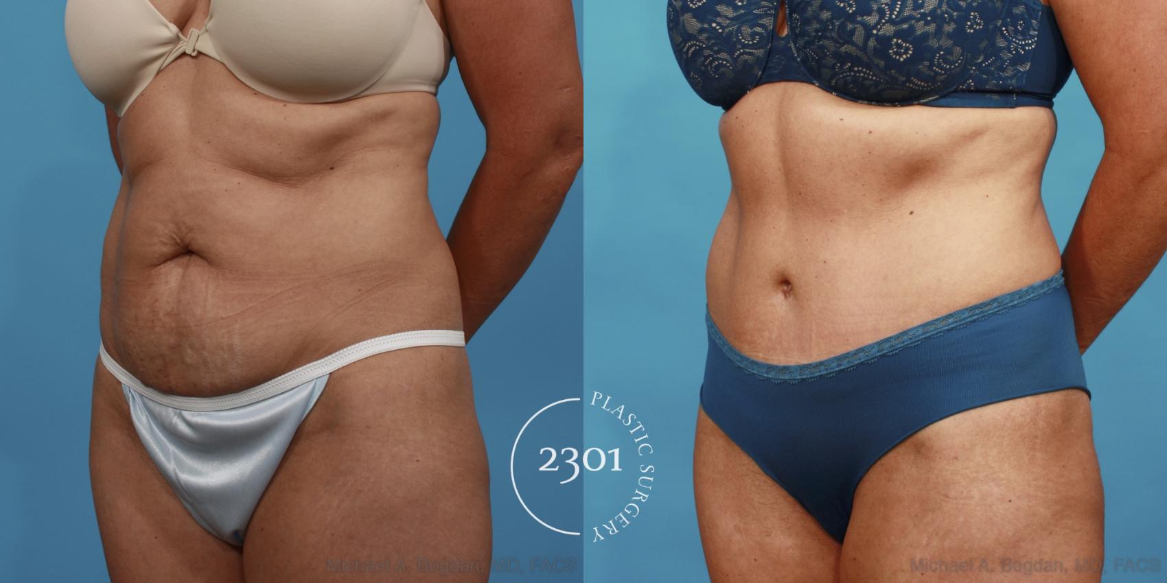 Before & After Tummy Tuck Case 521 View #2 View in Fort Worth, Plano, & Frisco, Texas