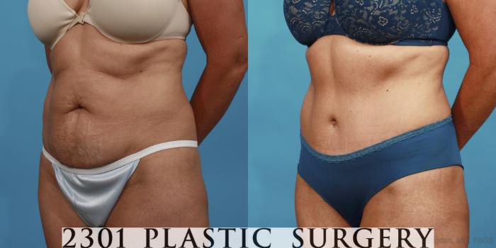 Before & After Tummy Tuck Case 521 View #2 View in Fort Worth, Plano, & Frisco, Texas