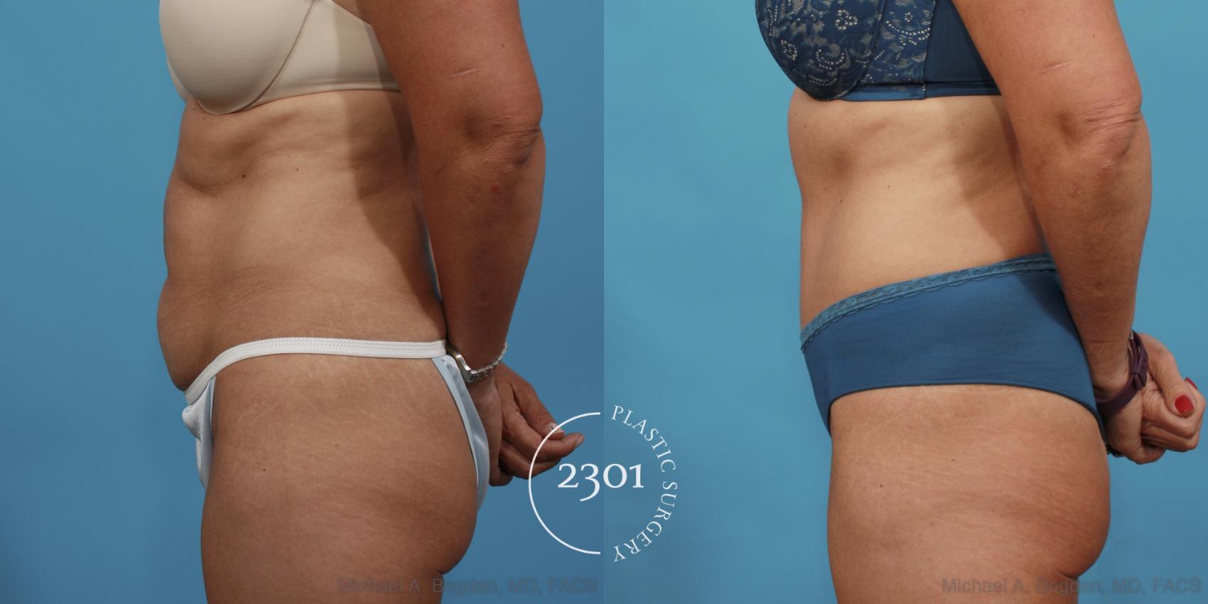 Before & After Tummy Tuck Case 521 View #3 View in Fort Worth, Plano, & Frisco, Texas