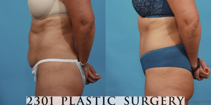 Before & After Tummy Tuck Case 521 View #3 View in Fort Worth, Plano, & Frisco, Texas