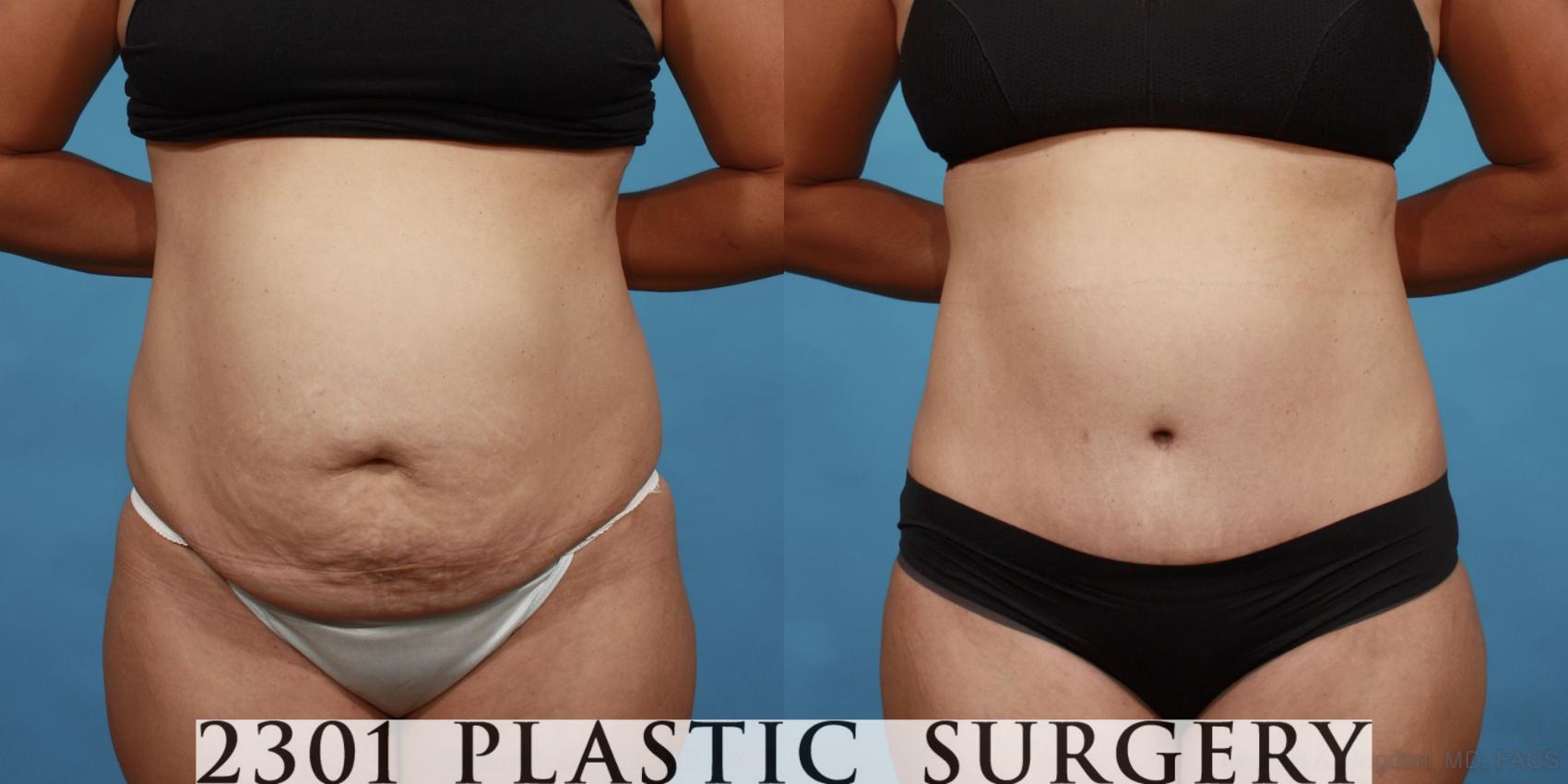 Before & After Liposuction Case 560 View #1 View in Fort Worth, Plano, & Frisco, Texas