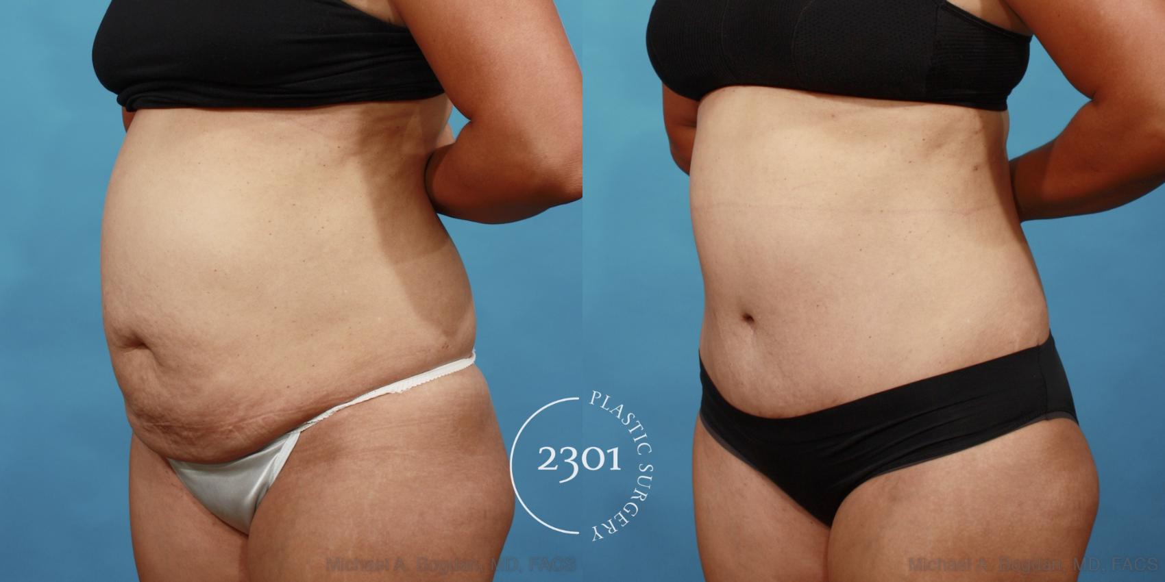 Before & After Tummy Tuck Case 560 View #2 View in Fort Worth, Plano, & Frisco, Texas
