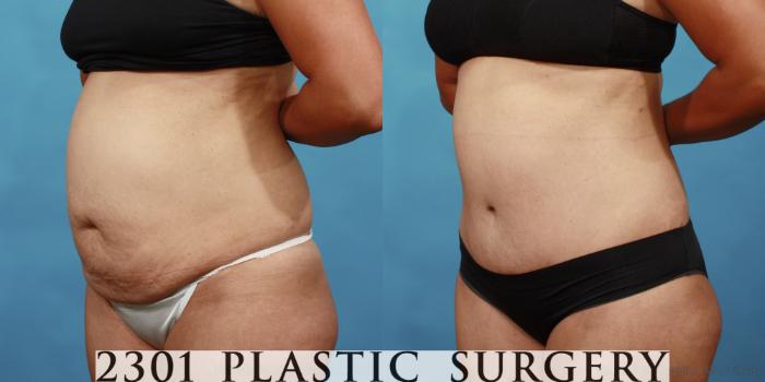 Before & After Liposuction Case 560 View #2 View in Fort Worth, Plano, & Frisco, Texas