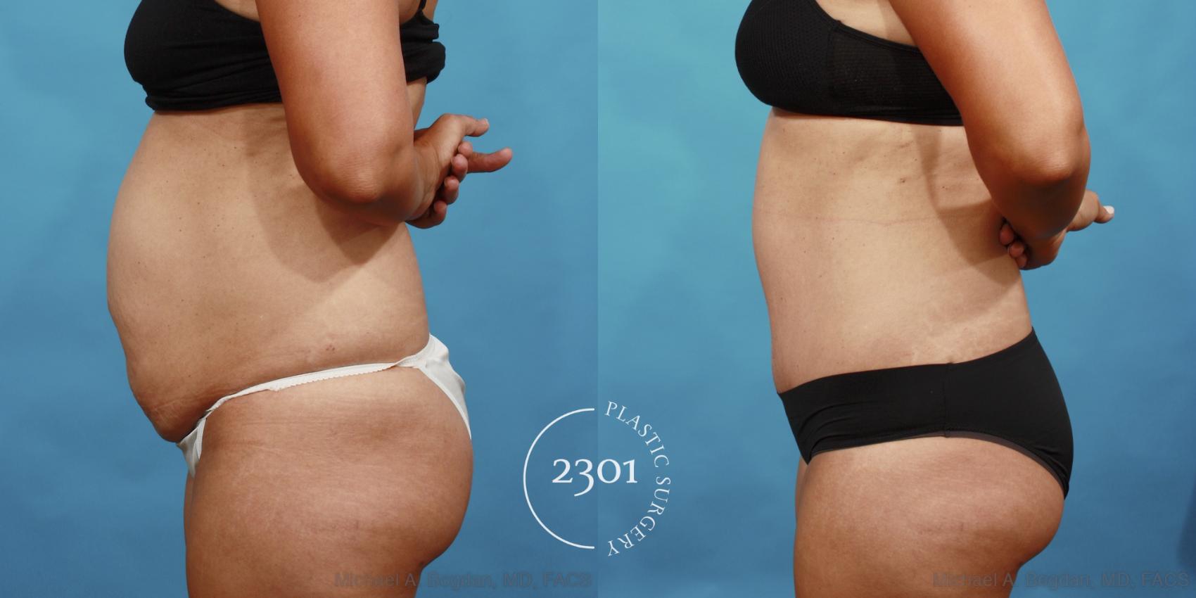 Before & After Tummy Tuck Case 560 View #3 View in Fort Worth, Plano, & Frisco, Texas