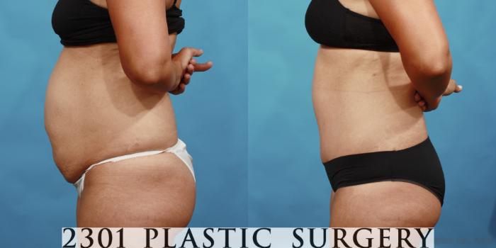 Before & After Liposuction Case 560 View #3 View in Fort Worth, Plano, & Frisco, Texas