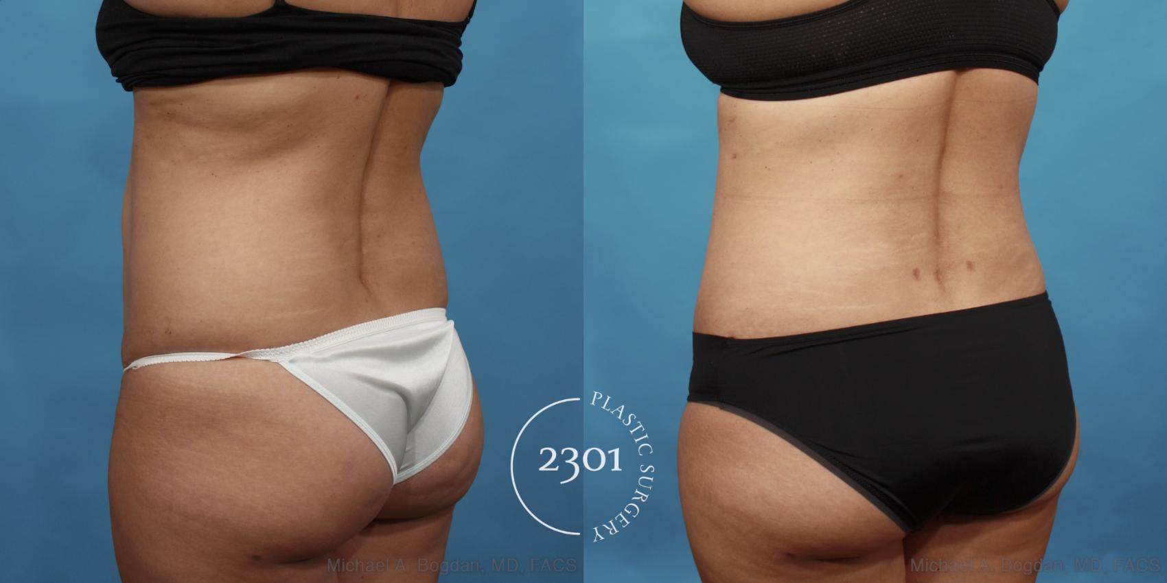 Before & After Tummy Tuck Case 560 View #4 View in Fort Worth, Plano, & Frisco, Texas