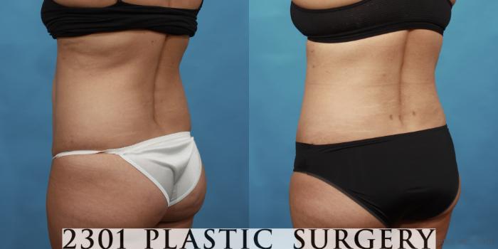 Before & After Liposuction Case 560 View #4 View in Fort Worth, Plano, & Frisco, Texas