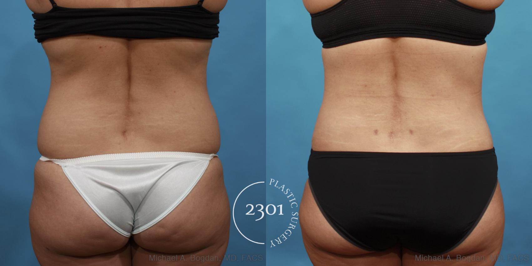 Before & After Tummy Tuck Case 560 View #5 View in Fort Worth, Plano, & Frisco, Texas