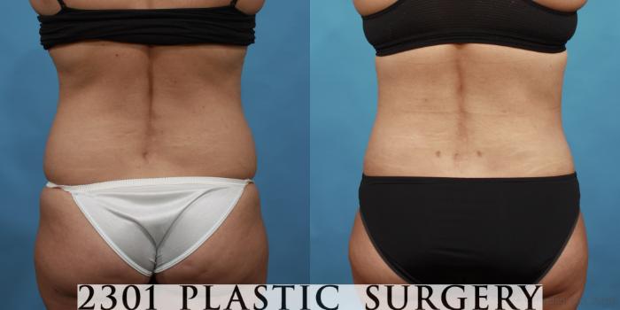 Before & After Liposuction Case 560 View #5 View in Fort Worth, Plano, & Frisco, Texas