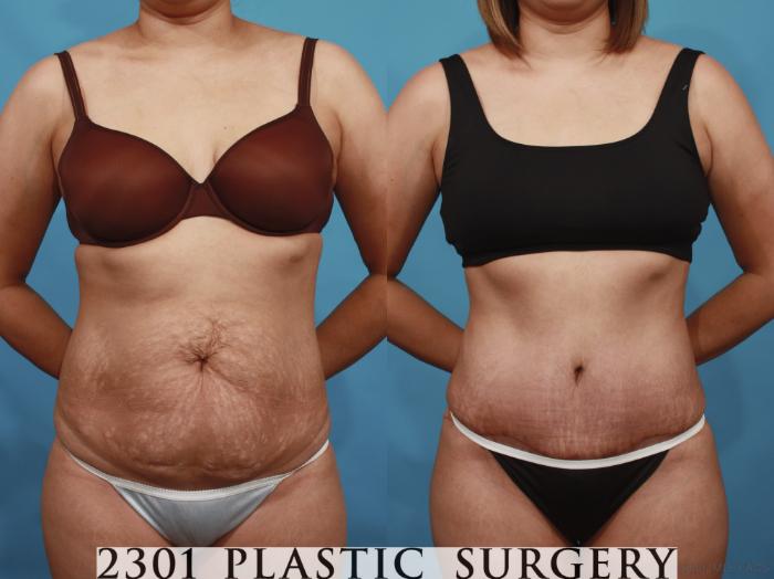 Before & After Tummy Tuck Case 606 View #1 View in Fort Worth, Plano, & Frisco, Texas