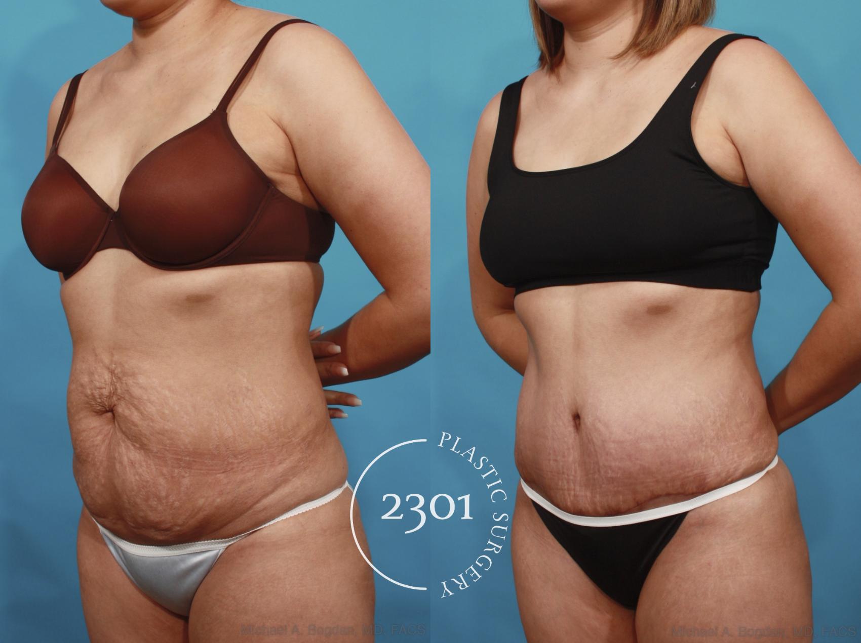 Before & After Tummy Tuck Case 606 View #2 View in Fort Worth, Plano, & Frisco, Texas