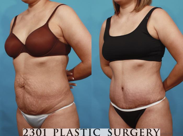 Before & After Tummy Tuck Case 606 View #2 View in Fort Worth, Plano, & Frisco, Texas