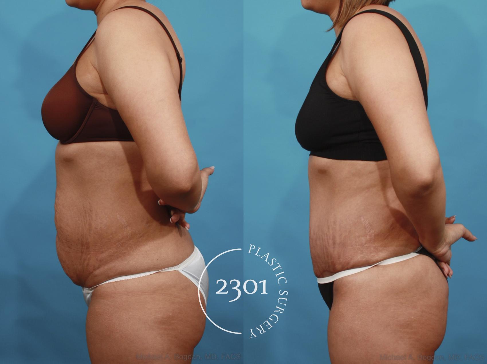 Before & After Tummy Tuck Case 606 View #3 View in Fort Worth, Plano, & Frisco, Texas