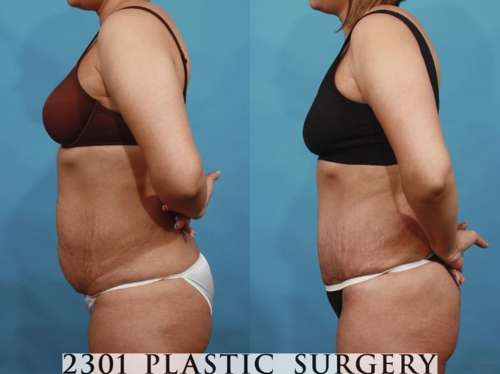 Before & After Tummy Tuck Case 606 View #3 View in Fort Worth, Plano, & Frisco, Texas