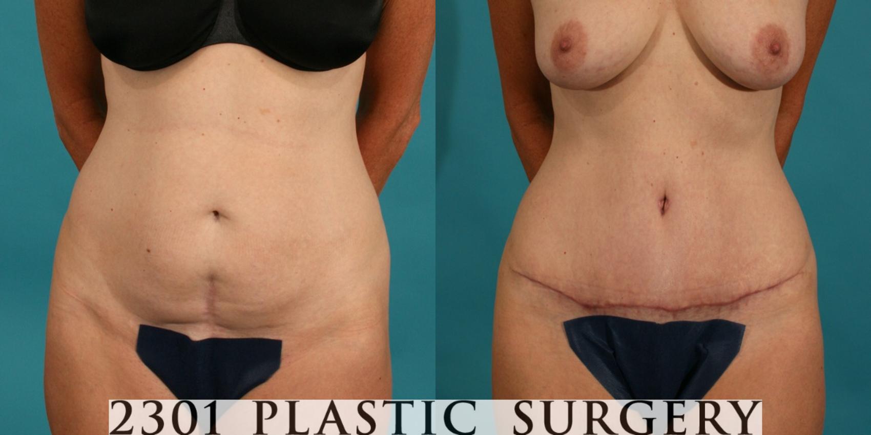 Before & After Tummy Tuck Case 61 View #1 View in Fort Worth, Plano, & Frisco, Texas