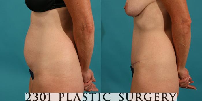 Before & After Tummy Tuck Case 61 View #2 View in Fort Worth, Plano, & Frisco, Texas