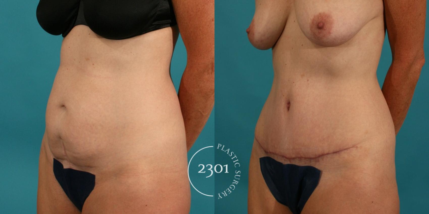 Before & After Tummy Tuck Case 61 View #3 View in Fort Worth, Plano, & Frisco, Texas