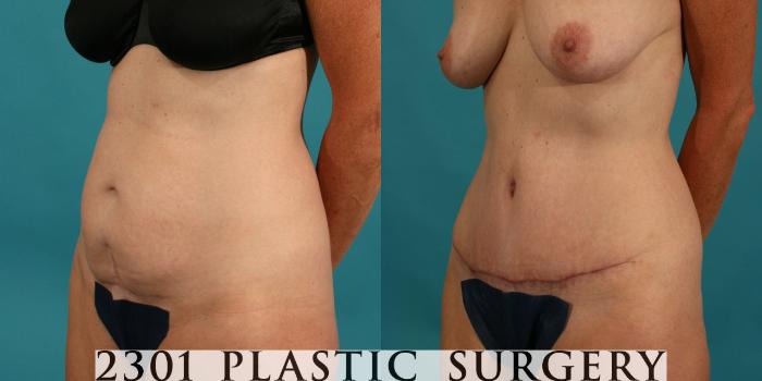 Before & After Tummy Tuck Case 61 View #3 View in Fort Worth, Plano, & Frisco, Texas