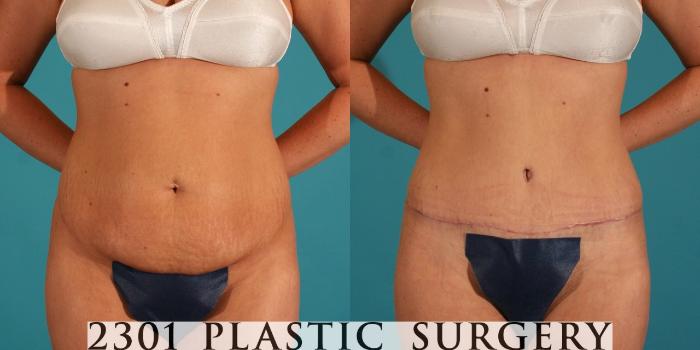Before & After Tummy Tuck Case 64 View #1 View in Fort Worth, Plano, & Frisco, Texas