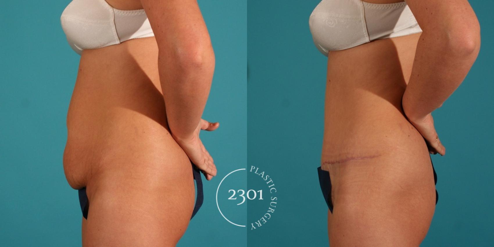 Before & After Tummy Tuck Case 64 View #2 View in Fort Worth, Plano, & Frisco, Texas
