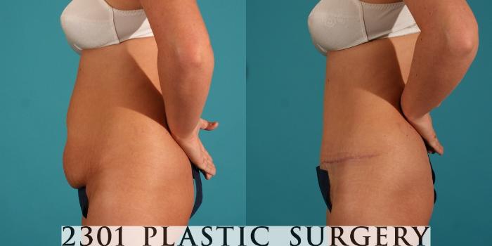 Before & After Tummy Tuck Case 64 View #2 View in Fort Worth, Plano, & Frisco, Texas
