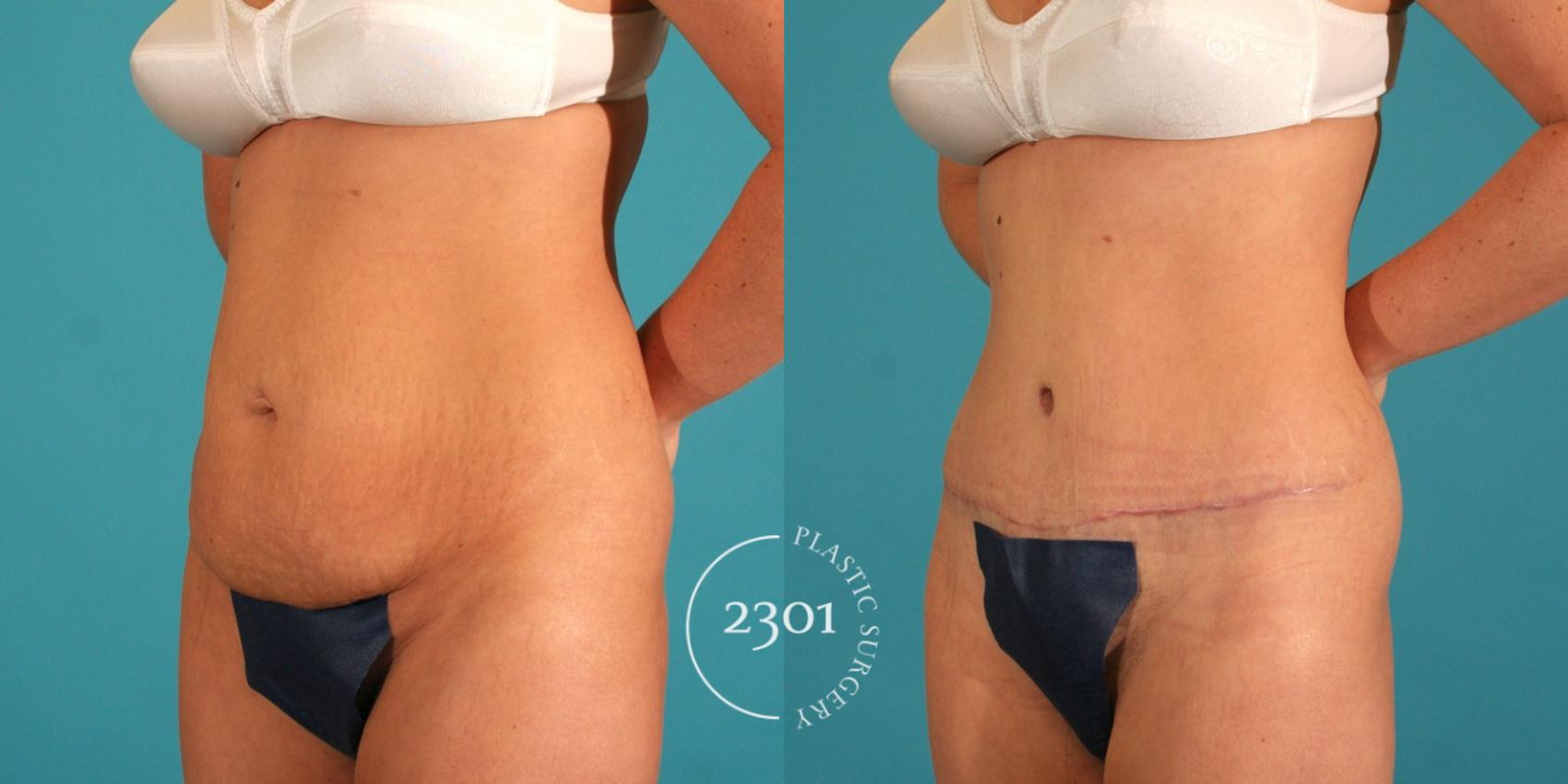 Before & After Tummy Tuck Case 64 View #3 View in Fort Worth, Plano, & Frisco, Texas