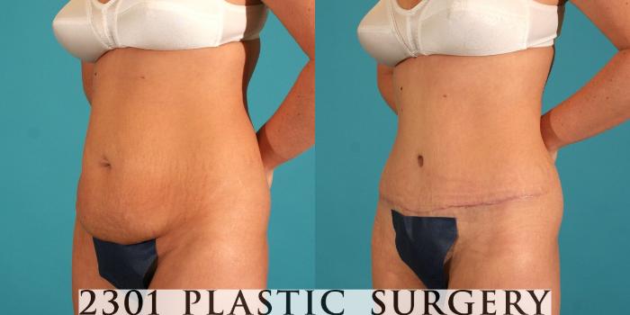 Before & After Tummy Tuck Case 64 View #3 View in Fort Worth, Plano, & Frisco, Texas