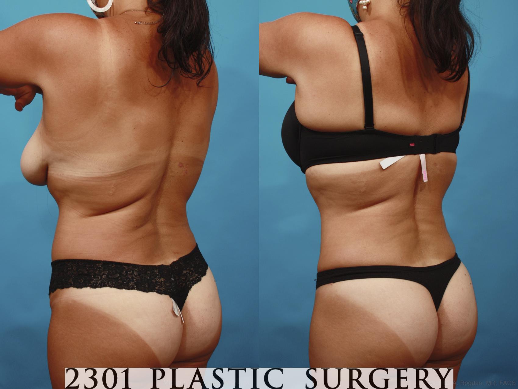 Before & After Tummy Tuck Case 648 Back Left Oblique View in Fort Worth & Frisco, Texas