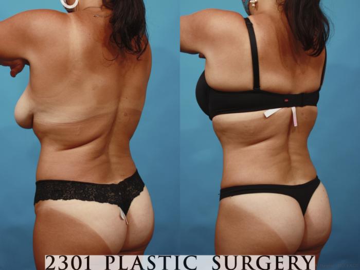 Before & After Tummy Tuck Case 648 Back Left Oblique View in Fort Worth, Plano, & Frisco, Texas