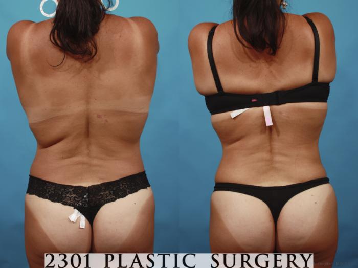 Before & After Tummy Tuck Case 648 Back View in Fort Worth, Plano, & Frisco, Texas