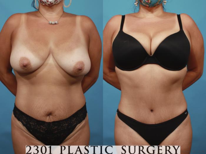 Before & After Tummy Tuck Case 648 Front View in Fort Worth, Plano, & Frisco, Texas