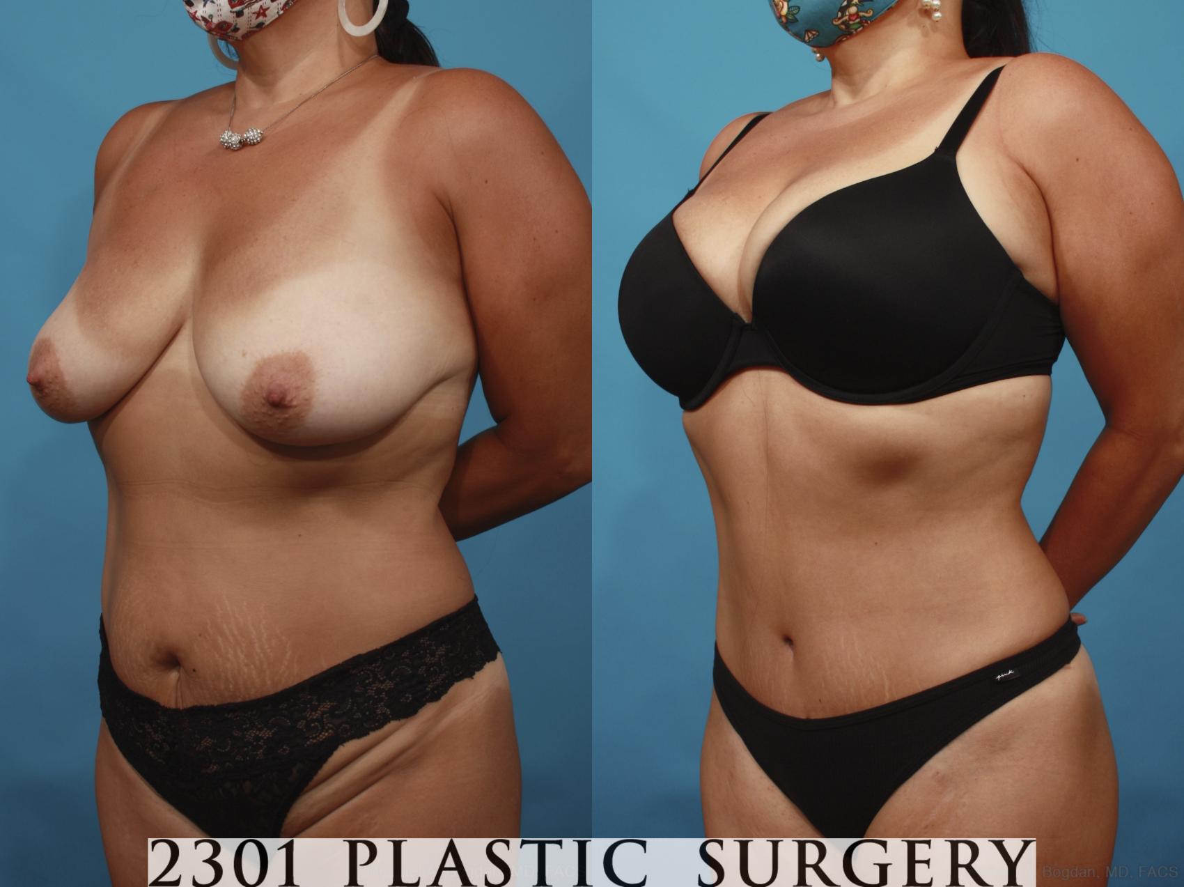 Before & After Tummy Tuck Case 648 Left Oblique View in Fort Worth & Frisco, Texas
