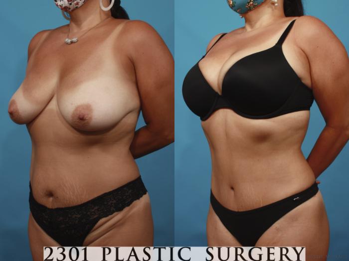 Before & After Tummy Tuck Case 648 Left Oblique View in Fort Worth, Plano, & Frisco, Texas