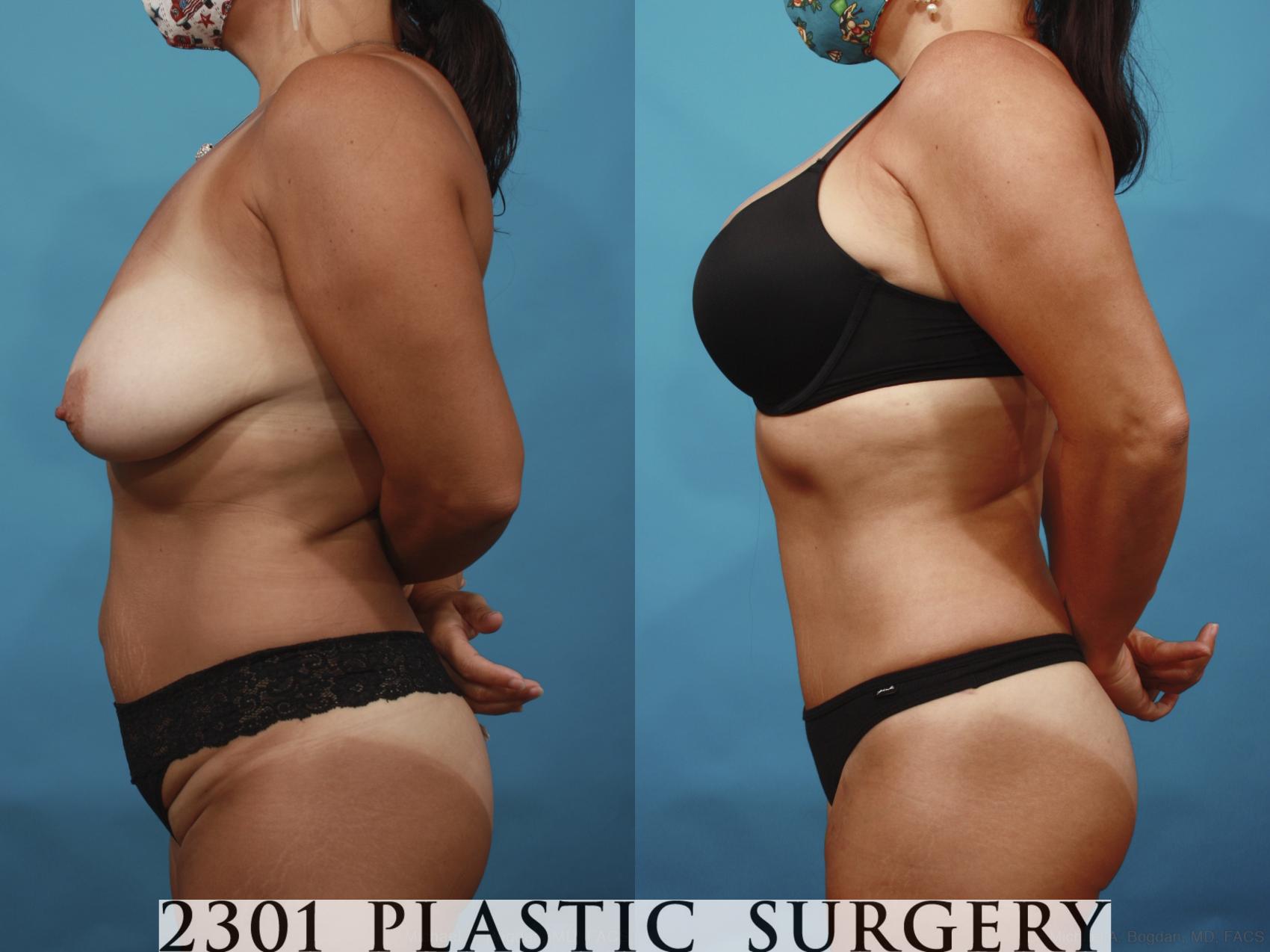 Before & After Tummy Tuck Case 648 Left Side View in Fort Worth & Frisco, Texas