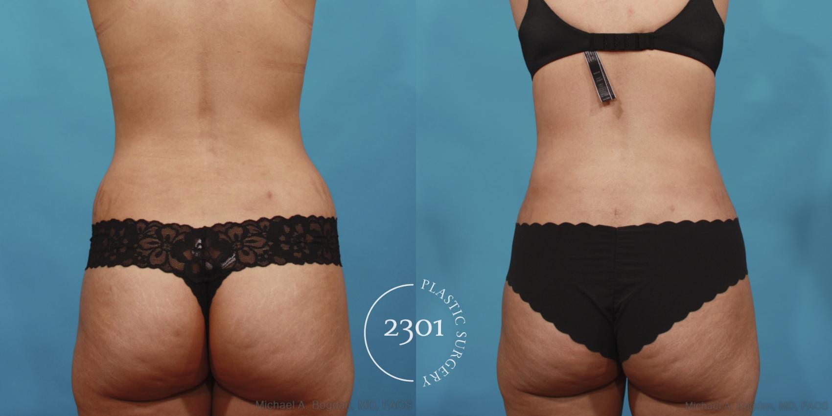 Before & After Tummy Tuck Case 649 Back View in Fort Worth, Plano, & Frisco, Texas