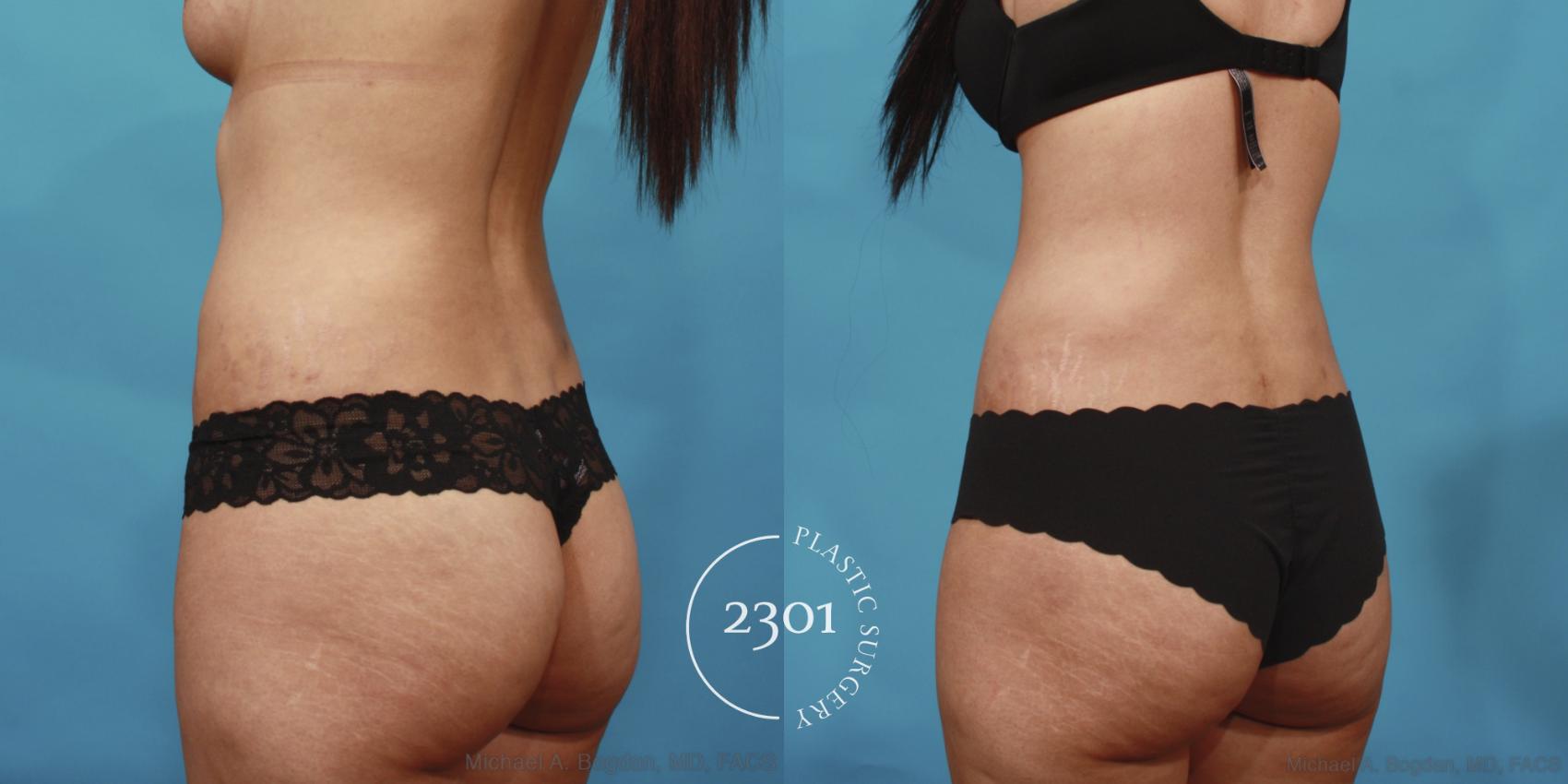 Before & After Tummy Tuck Case 649 Back Left Oblique View in Fort Worth, Plano, & Frisco, Texas