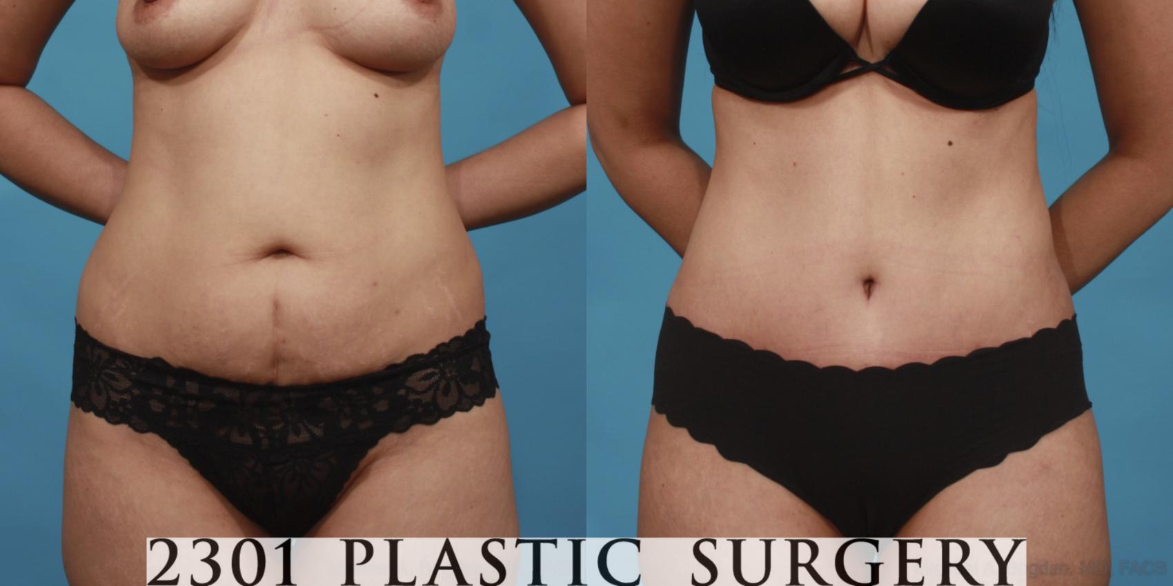 Before & After Tummy Tuck Case 649 Front View in Fort Worth, Plano, & Frisco, Texas