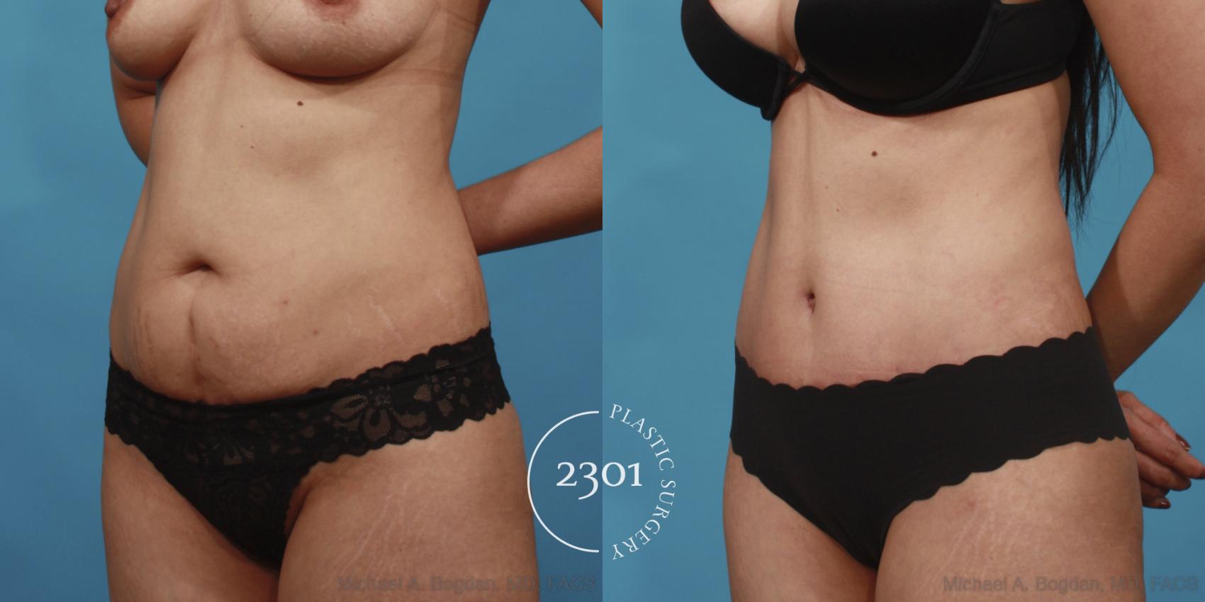 Before & After Tummy Tuck Case 649 Left Oblique View in Fort Worth, Plano, & Frisco, Texas